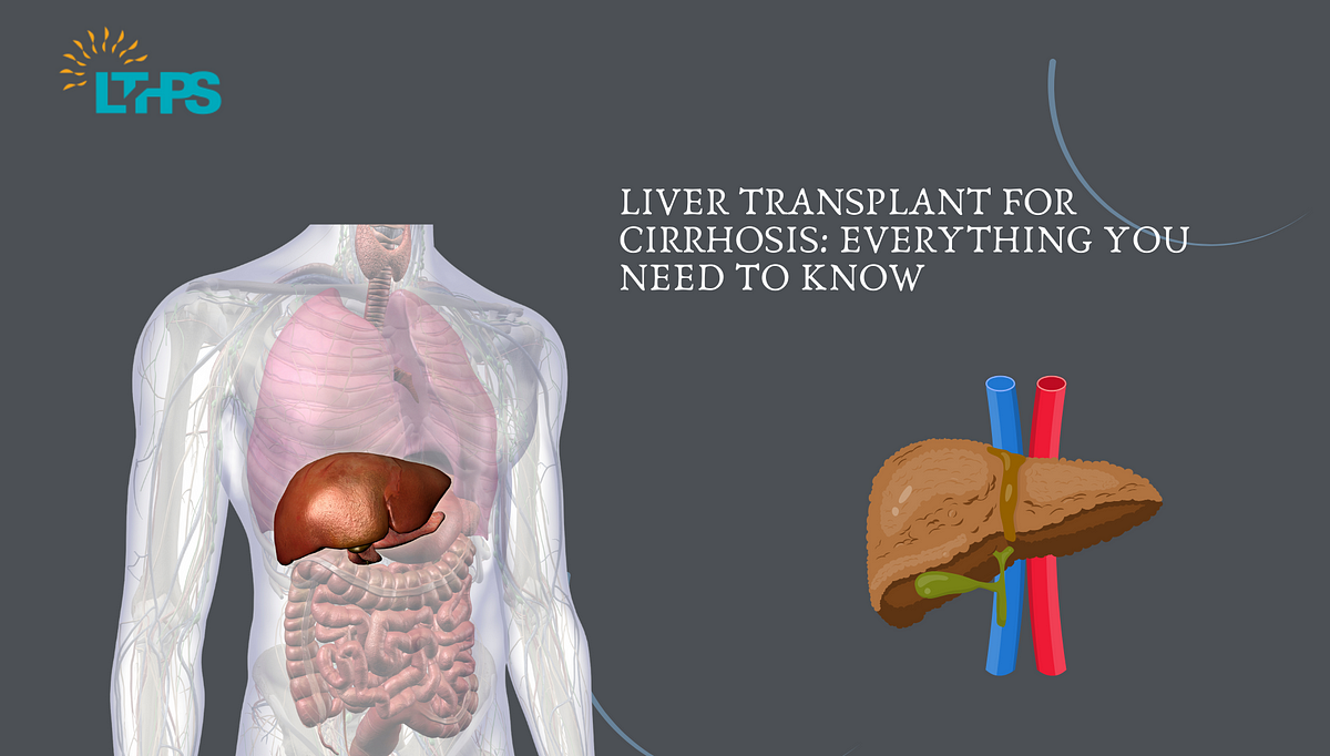 Liver Transplant For Cirrhosis: Everything You Need to Know | by Transplantationliver | Dec, 2024 | Medium